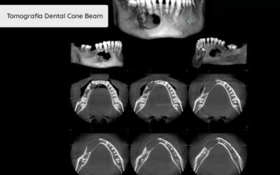 Tomografía Dental Cone Beam