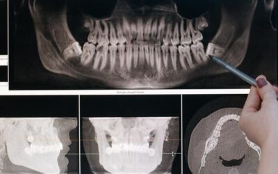 Se detectan dos casos de lesiones gracias a radiografías dentales
