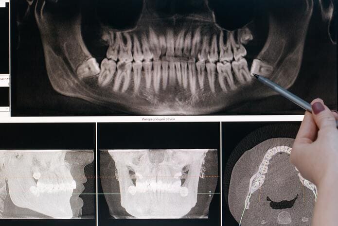 Se detectan dos casos de lesiones gracias a radiografías dentales