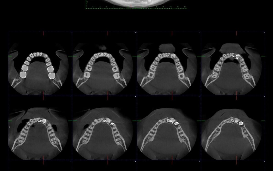 CBCT Tomografía Digital: Precisión Impecable con Mínima Radiación para Nuestros Pacientes