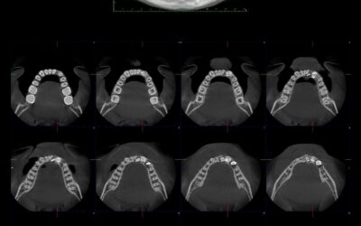 CBCT Tomografía Digital: Precisión Impecable con Mínima Radiación para Nuestros Pacientes