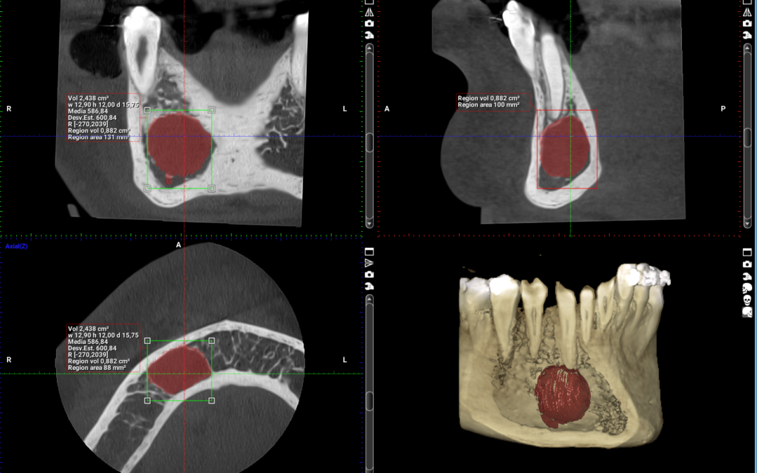 Tratamientos Eficaces Potenciados por Exploración 3D con Tomografía Dental en PROMAX3D